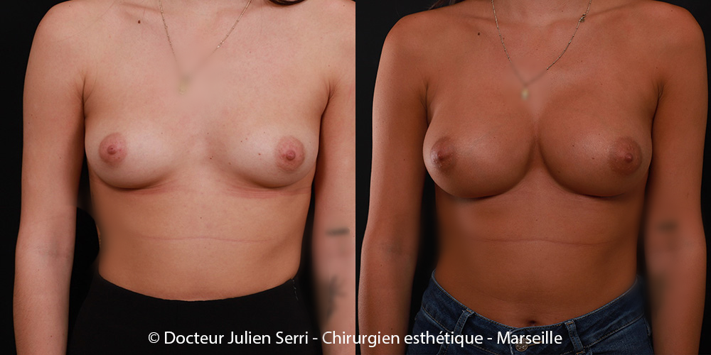 Chirurgie des seins - Implants mammaires ronds
