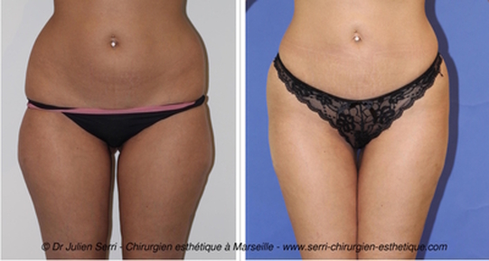 Bénéfice de la liposuccion de prélèvement de la graisse visible de face