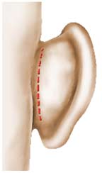 opération chirurgie oreilles décollées arrière