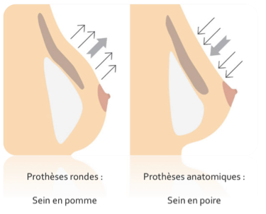 Augmentation mammaire par implants | Dr Serri chirurgien Marseille