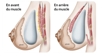 Augmentation mammaire par implants | Dr Serri chirurgien Marseille