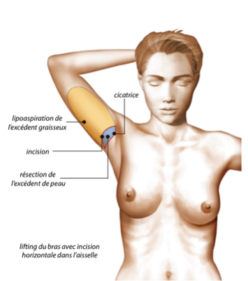 chirurgie des bras : cicatrices