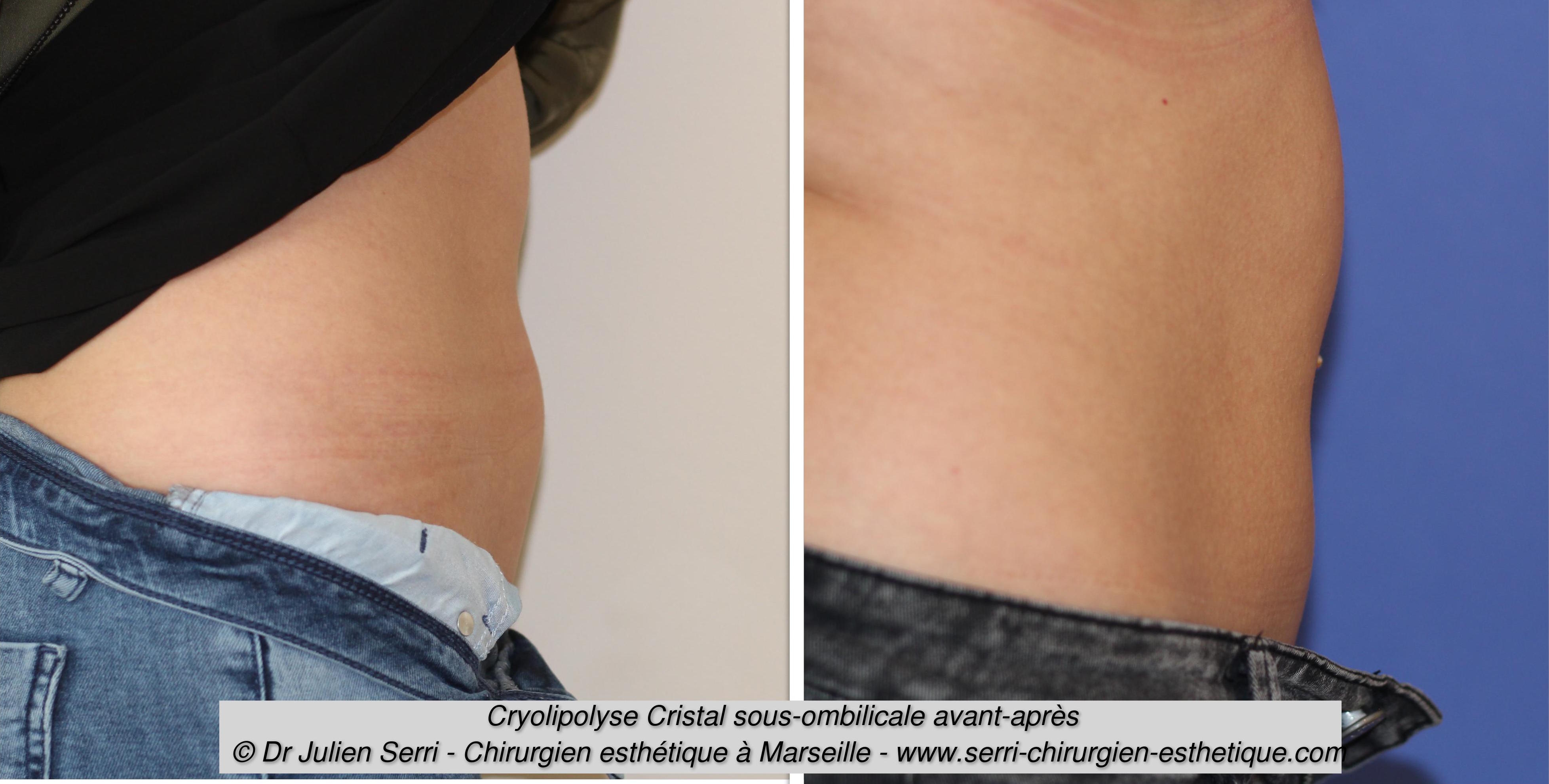 cryolipolyse a marseille dr serri chirurgien esthetique