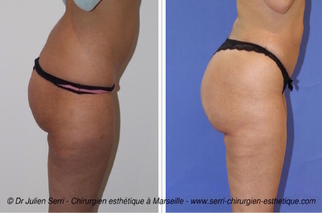chirurgien_esthetique_marseille_lipofilling_fesse_fessiers_avant_apres_2.jpg