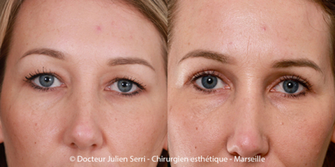 chirurgie-paupieres-face.jpg