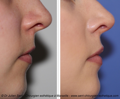 Acide Hyaluronique - Re-pulpage lèvres supérieures et inférieures